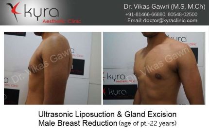 Ultrasonic Liposuction Gland Excision