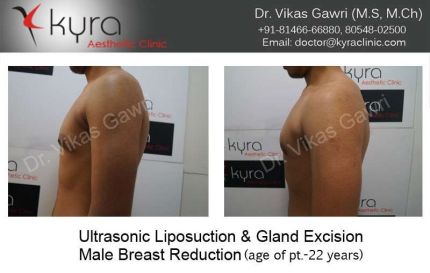 Ultrasonic Liposuction Gland Excision