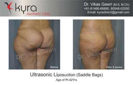 Ultrasonic Liposuction Saddle Bags