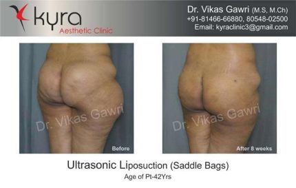 Ultrasonic Liposuction Saddle Bags