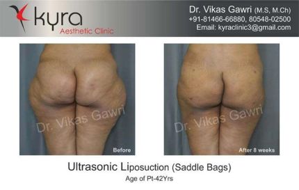 Ultrasonic Liposuction Saddle Bags