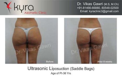 Ultrasonic Liposuction Saddle Bags