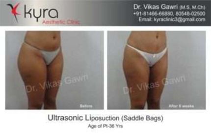 Ultrasonic Liposuction Saddle Bags