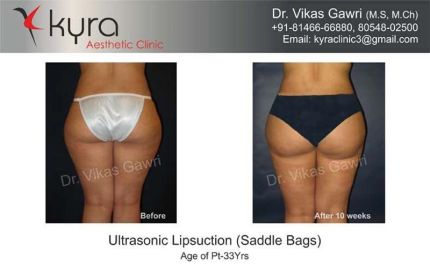 Ultrasonic Liposuction Saddle Bags