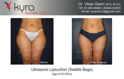 Ultrasonic Liposuction Saddle Bags