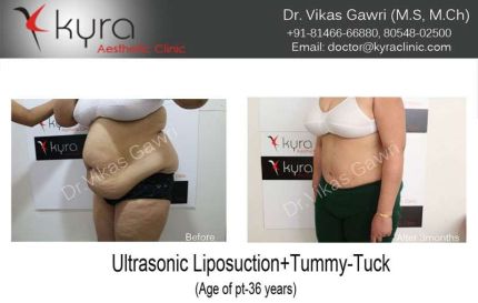 Ultrasonic Liposuction Tummy Tuck