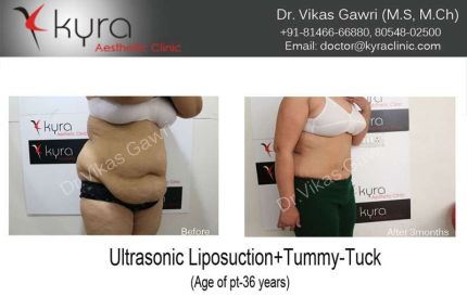 Ultrasonic Liposuction Tummy Tuck