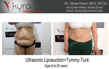 Ultrasonic Liposuction Tummy Tuck