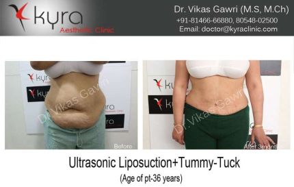 Ultrasonic Liposuction Tummy Tuck