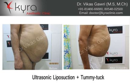 Ultrasonic Liposuction Tummy Tuck