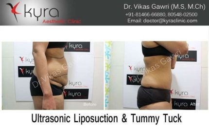 Ultrasonic Liposuction Tummy Tuck