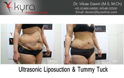 Ultrasonic Liposuction Tummy Tuck