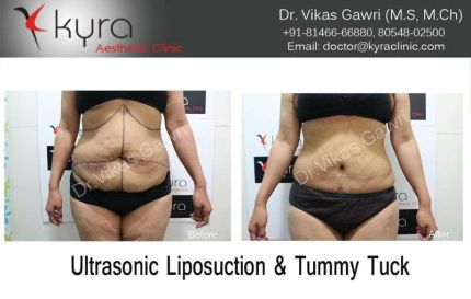 Ultrasonic Liposuction Tummy Tuck