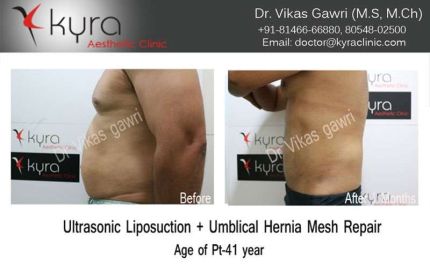 Ultrasonic Liposuction Umblical Hernia Mesh Repair