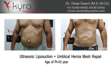 Ultrasonic Liposuction Umblical Hernia Mesh Repair