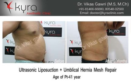 Ultrasonic Liposuction Umblical Hernia Mesh Repair