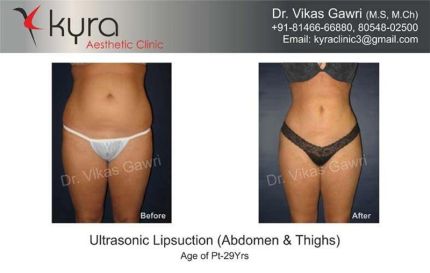 Ultrasonic Liposuction of Abdomen thighs