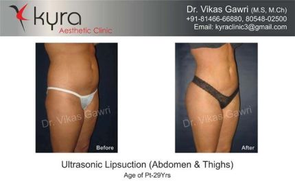 Ultrasonic Liposuction of Abdomen thighs