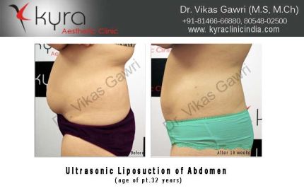 Ultrasonic Liposuction of Abdomen