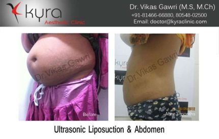 Ultrasonic Liposuction of Abdomen