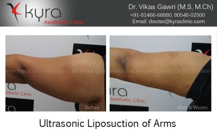 Ultrasonic Liposuction of Arms