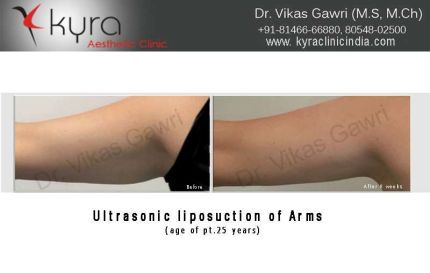 Ultrasonic Liposuction of Arms