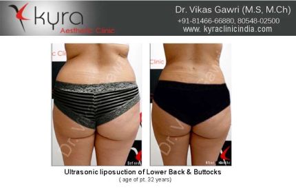 Ultrasonic Liposuction of Lower Back Buttocks