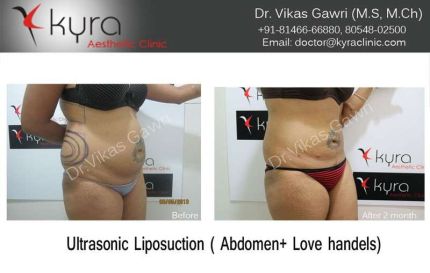 Ultrasonic Liposuction of abdomen Love handels