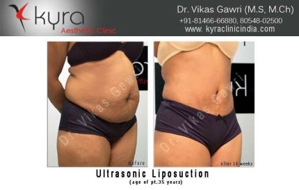 Ultrasonic Liposuction