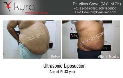 Ultrasonic Liposuction