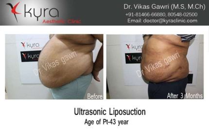 Ultrasonic Liposuction