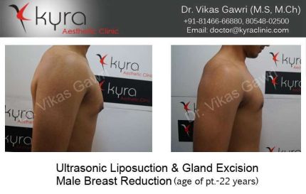 Ultrasonic liposuction Gland Excision