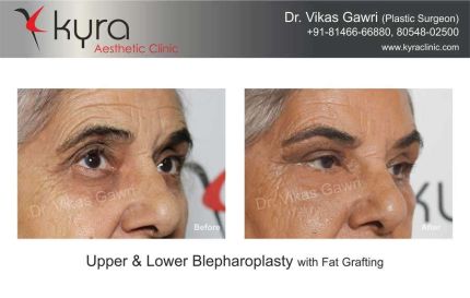 Upper Lower Blepharoplasty With Fat Grafting