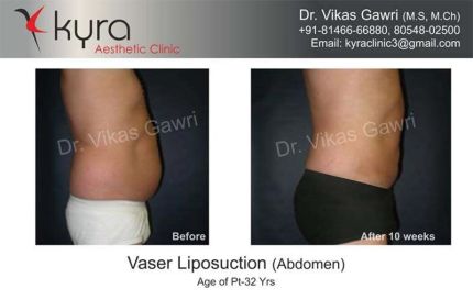 Vaser Liposuction Abdomen