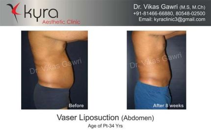 Vaser Liposuction Abdomen