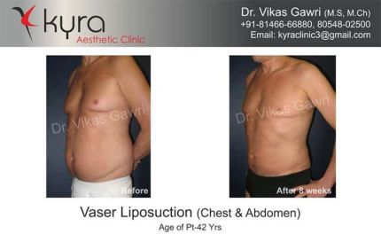 Vaser Liposuction Cheast Abdomen