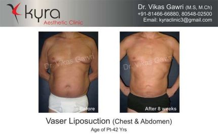 Vaser Liposuction Cheast Abdomen