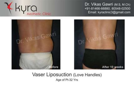 Vaser Liposuction Love Handles