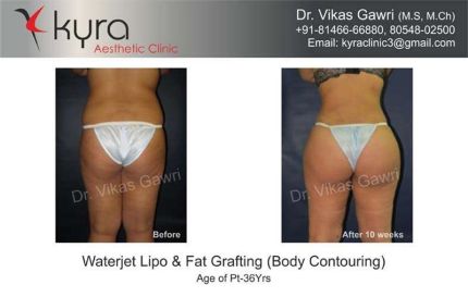 Waterjet Lipo Fat Grafting Body Contouring