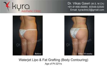 Waterjet Lipo Fat Grafting Body Contouring