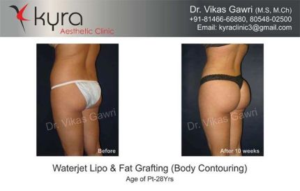 Waterjet Lipo Fat Grafting Body Contouring