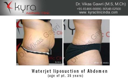 Waterjet Liposuction of Abdomen2