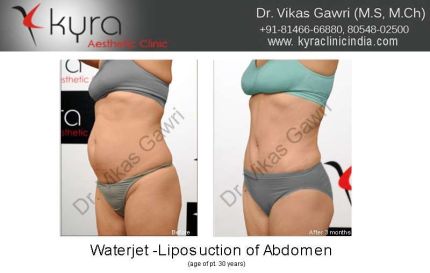 Waterjet Liposuction of Abdomen