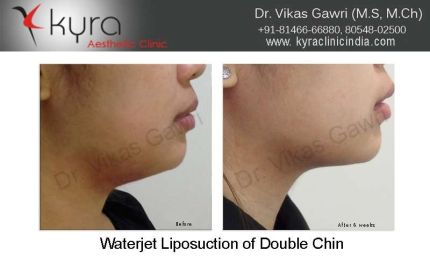 Waterjet Liposuction of Double Chin