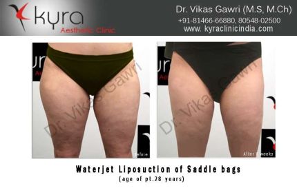 Waterjet Liposuction of Saddle Bags