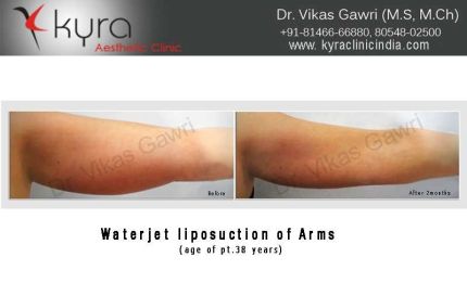 Waterjet Liposuction of arms