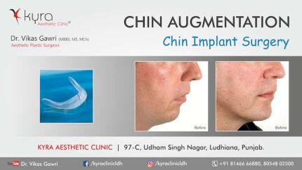 chin implant surgary