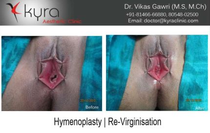 hymenoplasty Re virginisation