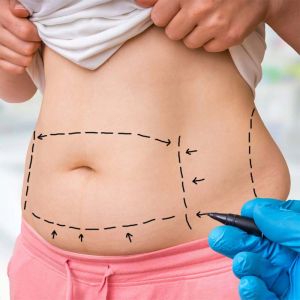 Tummy Tuck Surgery in Ludhiana