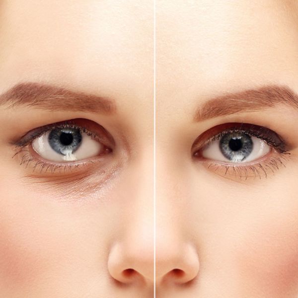 Best Eyelid Surgery Doctors in Ludhiana